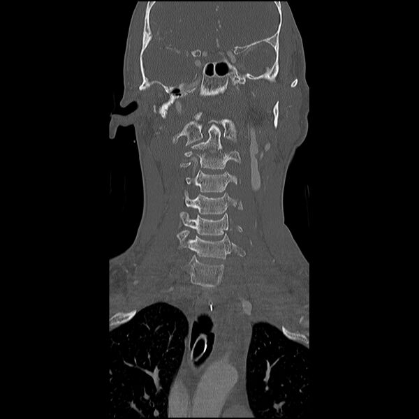 File:Cervical spine fractures with vertebral artery dissection (Radiopaedia 32135-33078 Coronal bone window 8).jpg