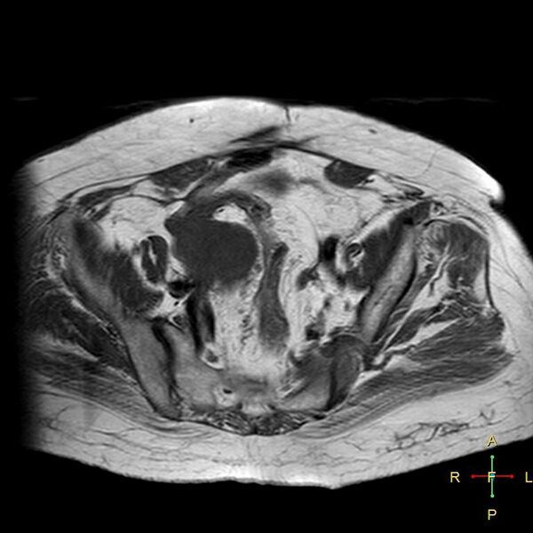 File:Cervical stump squamous cell carcinoma (Radiopaedia 48049-52858 Axial T1 14).jpg