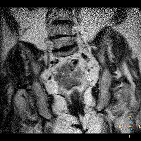File:Cervical stump squamous cell carcinoma (Radiopaedia 48049-52858 Coronal T2 12).jpg