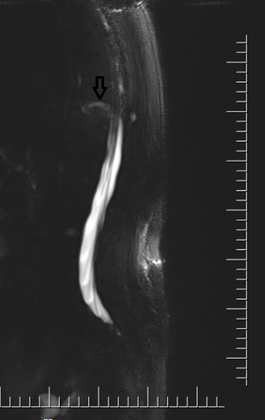 File:Chalk stick fracture - ankylosing spondylitis (Radiopaedia 52572-58485 Sagittal Myelogram 1).png