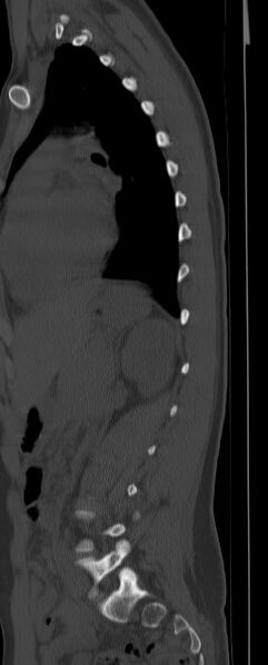 File:Chance fracture (Radiopaedia 45345-49372 Sagittal bone window 21).jpg