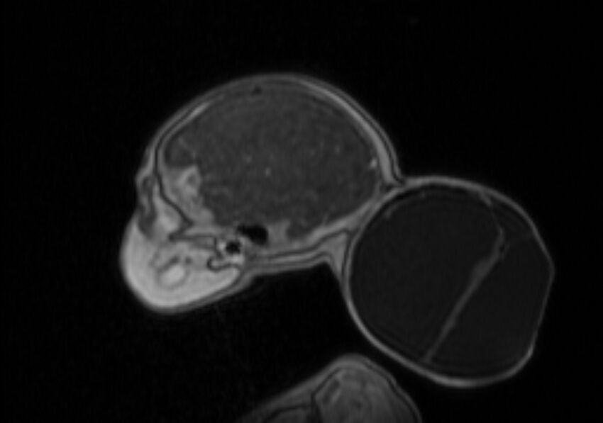 Chiari III malformation with occipital encephalocele (Radiopaedia 79446-92559 Sagittal T1 C+ mpr 17).jpg