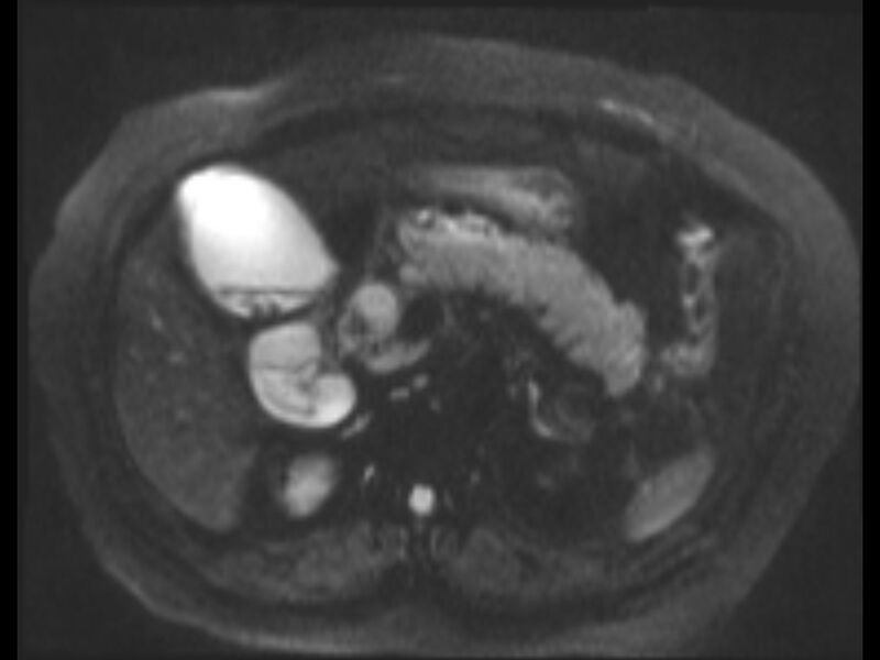 File:Choledocholithiasis causing intrahepatic biliary duct dilation (Radiopaedia 39908-42369 Axial T2 SPAIR 40).jpg