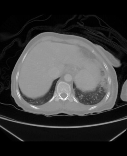 File:Chondrosarcoma (Radiopaedia 79427-92535 Axial lung window 46).jpg