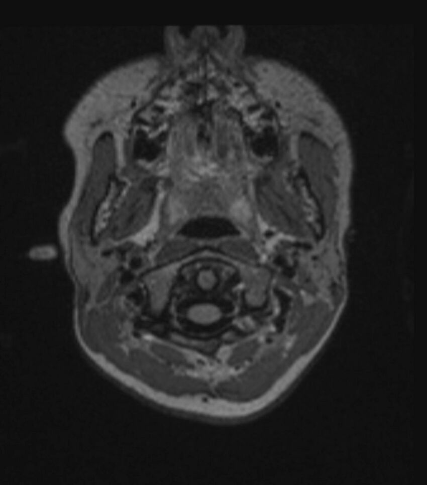 Choroid plexus carcinoma (Radiopaedia 91013-108553 Axial FLAIR C+ 59).jpg