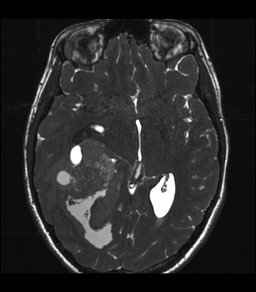 Choroid plexus carcinoma (Radiopaedia 91013-108553 Axial T2 CISS 33).jpg