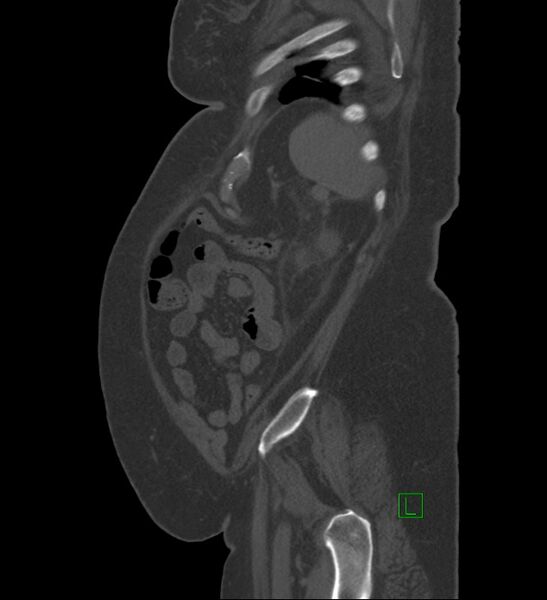 File:Chromophobe renal cell carcinoma (Radiopaedia 84239-99519 Sagittal bone window 15).jpg