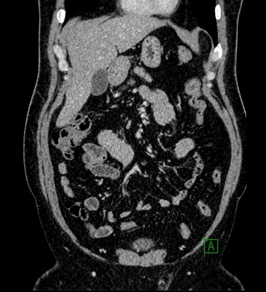 File:Chromophobe renal cell carcinoma (Radiopaedia 84286-99573 H 55).jpg