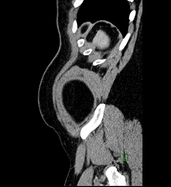 File:Chromophobe renal cell carcinoma (Radiopaedia 84286-99573 I 8).jpg