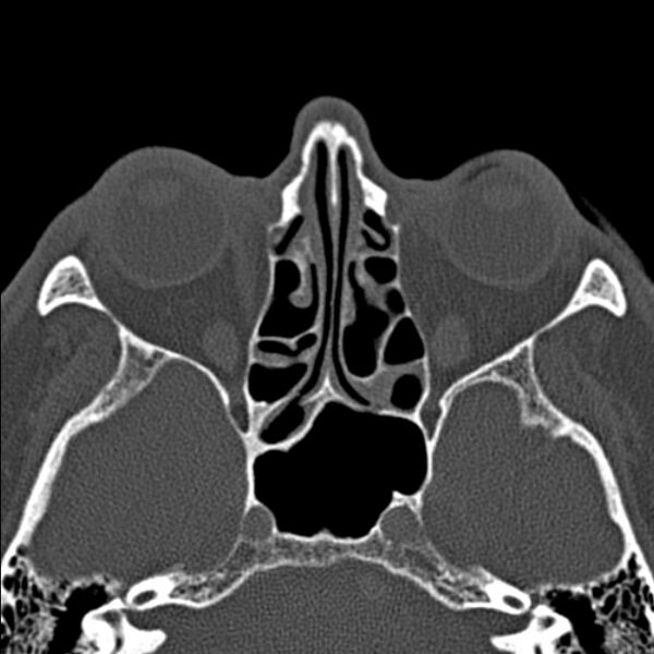 File:Chronic maxillary sinusitis (Radiopaedia 27879-28116 Axial bone window 31).jpg