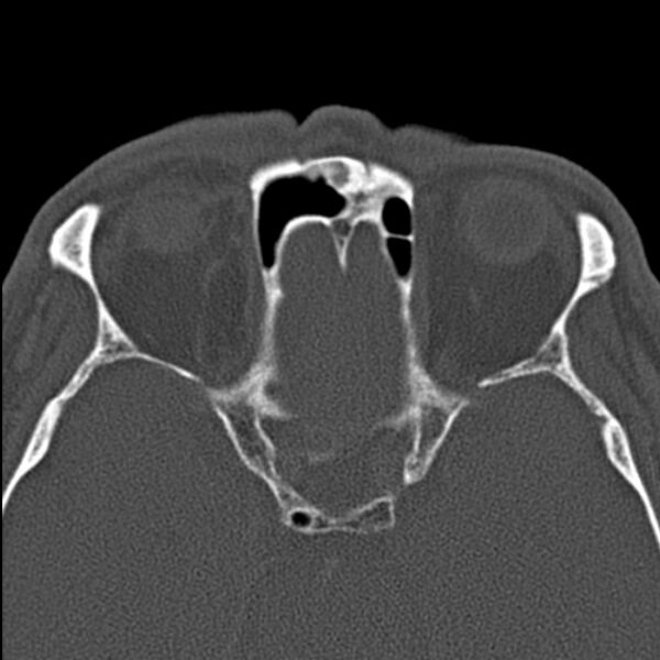 File:Chronic maxillary sinusitis (Radiopaedia 27879-28116 Axial bone window 40).jpg