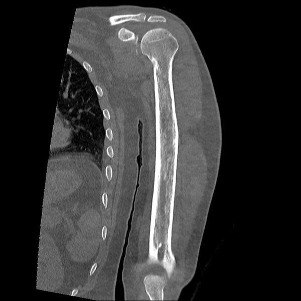 File:Chronic osteomyelitis (Radiopaedia 67597-76998 Coronal bone window 10).jpg