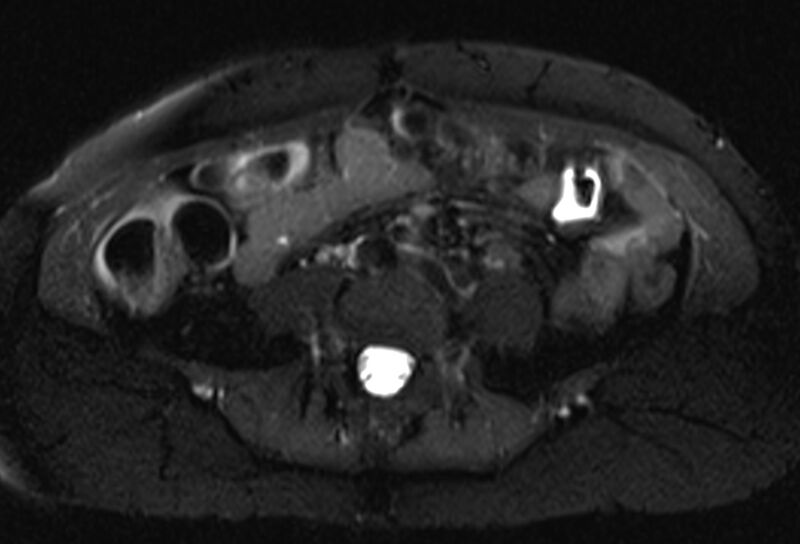 File:Chronic pancreatitis - pancreatic duct calculi (Radiopaedia 71818-82250 Axial T2 fat sat 51).jpg