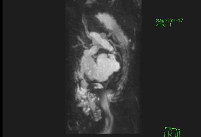 File:Chronic pancreatitis - pancreatic duct calculi (Radiopaedia 71818-82250 MRCP T2 5).jpg