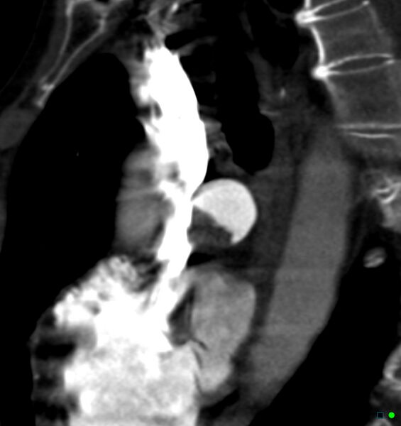 File:Chronic pulmonary embolism (Radiopaedia 17943-17702 Sagittal C+ CTPA 7).jpg