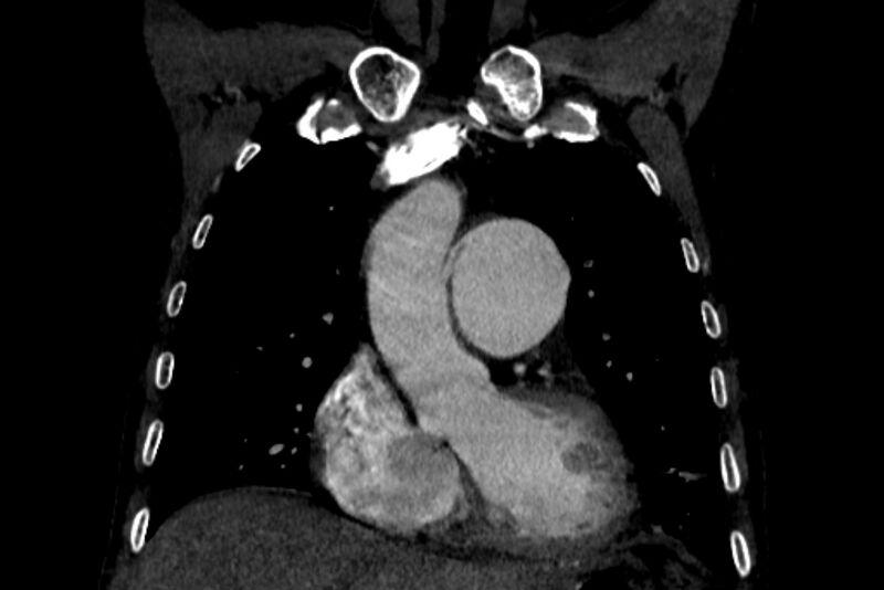 File:Chronic pulmonary embolism with bubbly consolidation (Radiopaedia 91248-108850 B 48).jpg