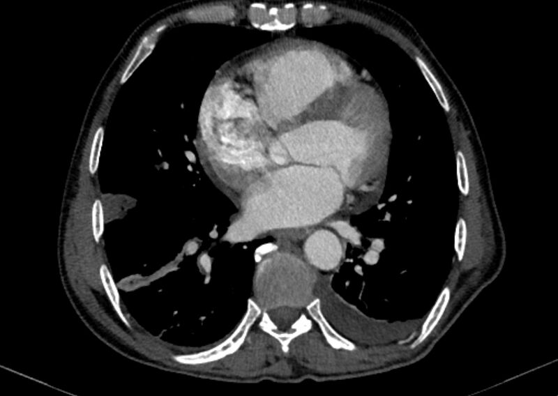 File:Chronic pulmonary embolism with bubbly consolidation (Radiopaedia 91248-108850 C+ arterial phase 96).jpg