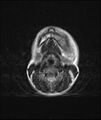 Chronic reactive multifocal osteomyelitis (CRMO) - mandible (Radiopaedia 56405-63069 Axial T2 5).jpg