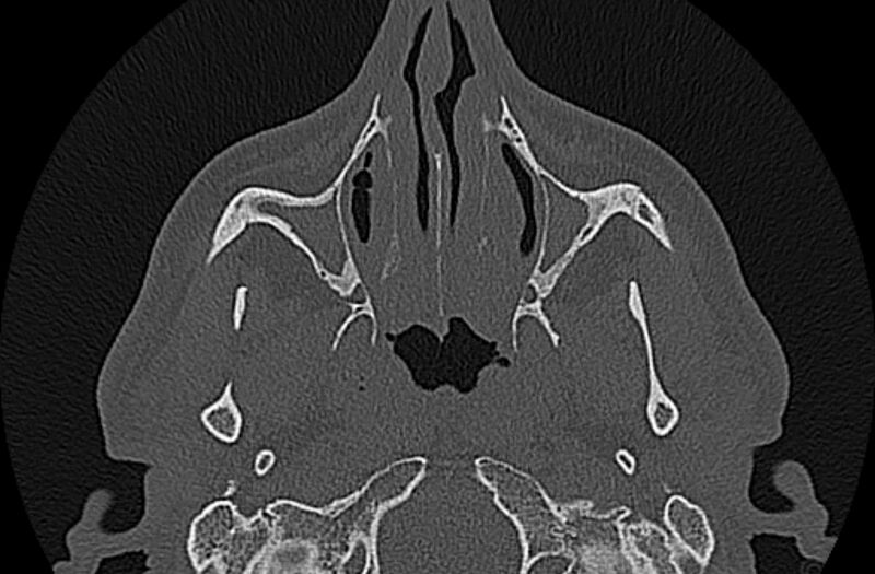 File:Chronic rhinosinusitis (Radiopaedia 65079-74075 Axial bone window 21).jpg