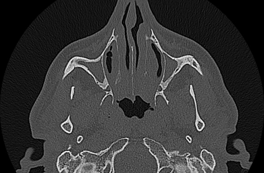 Chronic rhinosinusitis (Radiopaedia 65079-74075 Axial bone window 21).jpg
