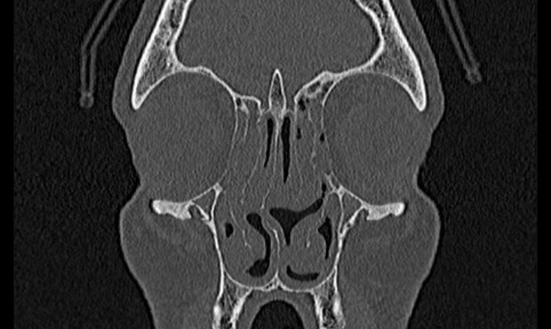 File:Chronic rhinosinusitis (Radiopaedia 65079-74075 Coronal bone window 21).jpg