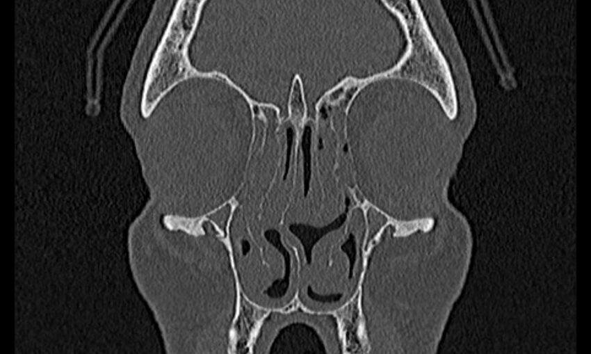 Chronic rhinosinusitis (Radiopaedia 65079-74075 Coronal bone window 21).jpg