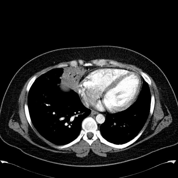 File:Chronic thromboembolic pulmonary hypertension (CTEPH) (Radiopaedia 74597-85531 Axial C+ CTPA 35).jpg