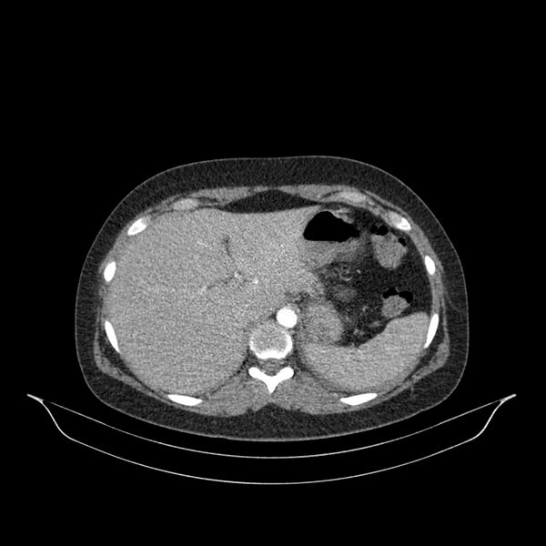 File:Chronic thromboembolic pulmonary hypertension (CTEPH) (Radiopaedia 74597-85532 Axial C+ CTPA 3).jpg