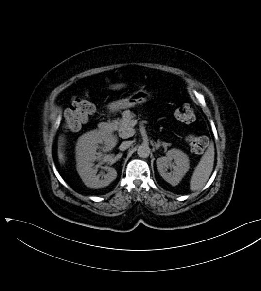 File:Clear cell renal cell carcinoma (Radiopaedia 85004-100537 Axial non-contrast 6).jpg