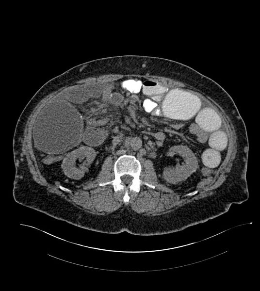 File:Closed-loop small bowel obstruction-internal hernia (Radiopaedia 78439-91096 Axial non-contrast 71).jpg