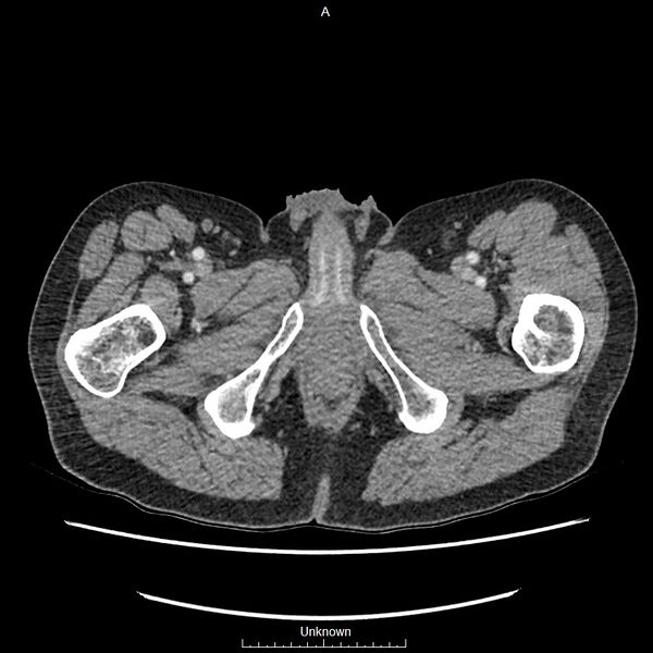 File:Closed loop bowel obstruction and ischemia (Radiopaedia 86959-103180 A 98).jpg