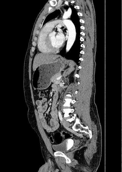 File:Coarctation of the aorta (Radiopaedia 49784-55050 C 67).jpg