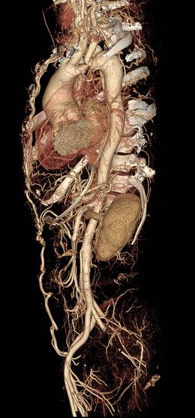 File:Coarctation of the aorta (Radiopaedia 8681-9490 A 1).jpg