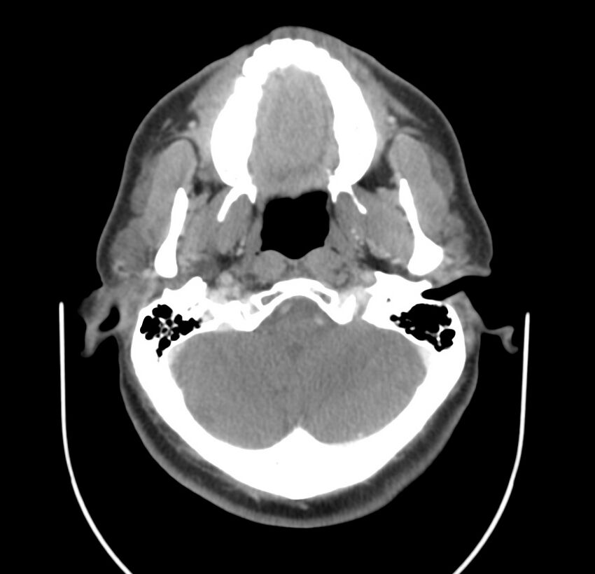 Colloid cyst of thyroid (Radiopaedia 22897-22923 Axial C+ delayed 15).jpg