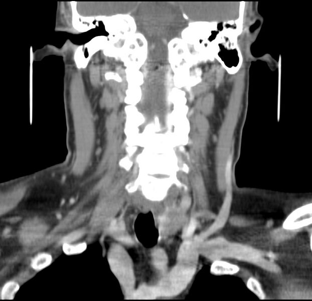 File:Colloid cyst of thyroid (Radiopaedia 22897-22923 Coronal C+ delayed 35).jpg