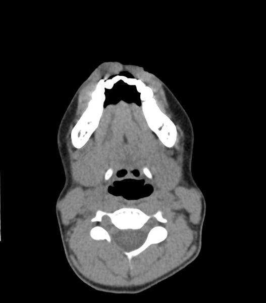 File:Nasoorbitoethmoid fracture (Radiopaedia 90044-107205 Axial non-contrast 53).jpg