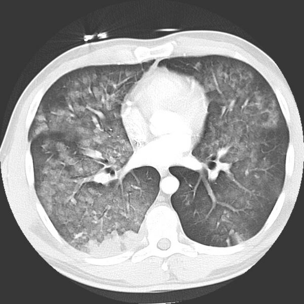 File:Near drowning pulmonary edema (Radiopaedia 16868-16591 Axial lung window 28).jpg