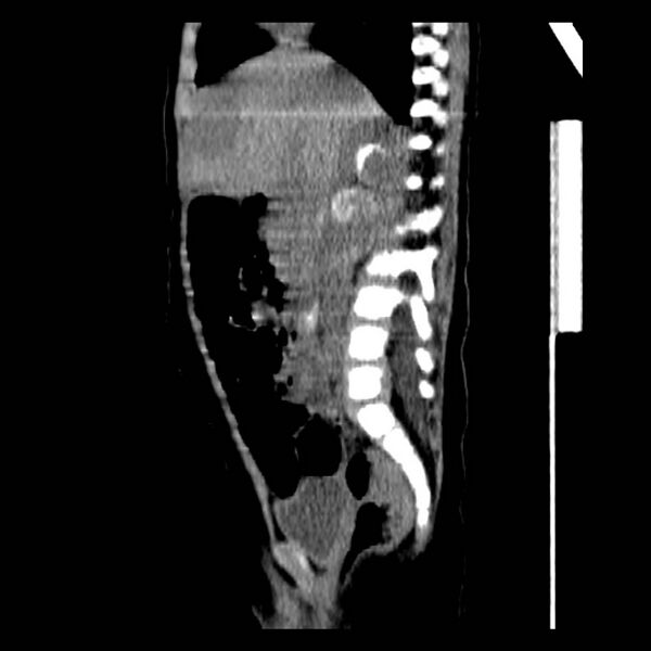 File:Neuroblastoma with skull metastases (Radiopaedia 30326-30960 B 19).jpg