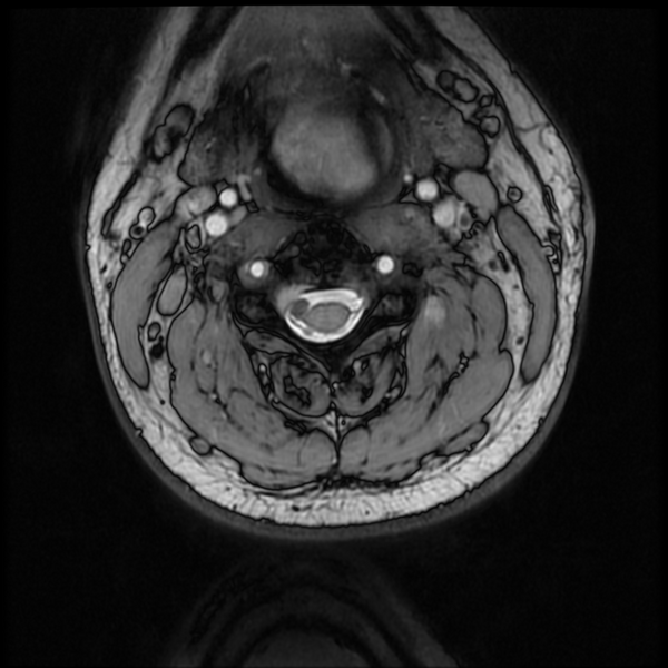 File:Neurofibromatosis type 2 (Radiopaedia 44936-48837 Axial Gradient Echo 33).png