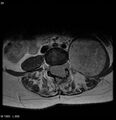 Neurofibromatosis type 2 - cranial and spinal involvement (Radiopaedia 5351-7112 Axial T1 C+ 28).jpg