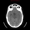 Neuroglial cyst (Radiopaedia 10713-11185 Axial non-contrast 20).jpg