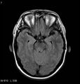 Neurosarcoidosis (Radiopaedia 10930-11351 Axial FLAIR 7).jpg