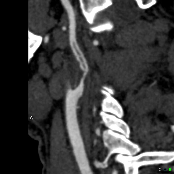 File:Non-occlusive intraluminal internal carotid artery thrombus (Radiopaedia 37751-39658 A 60).jpg