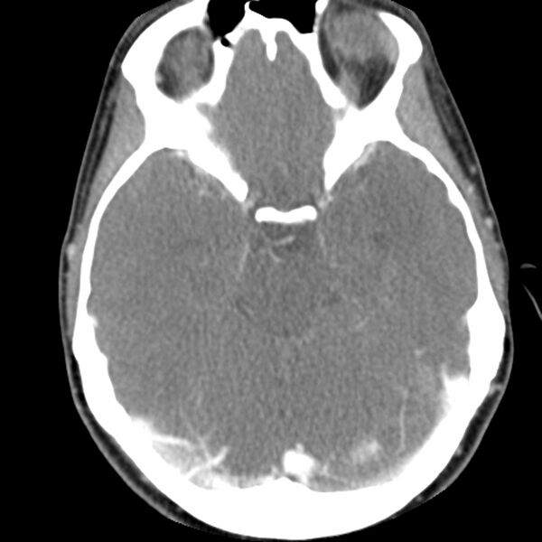 File:Normal CT of the neck (Radiopaedia 14575-14500 Axial C+ 4).jpg