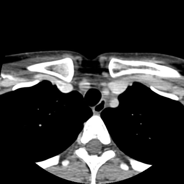 File:Normal CT of the neck (Radiopaedia 14575-14500 Axial C+ 69).jpg