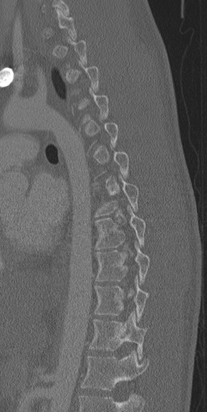 File:Normal CT thoracic spine (Radiopaedia 40181-42688 Sagittal bone window 24).png