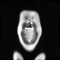 Normal MRI abdomen in pregnancy (Radiopaedia 88001-104541 Coronal T2 5).jpg