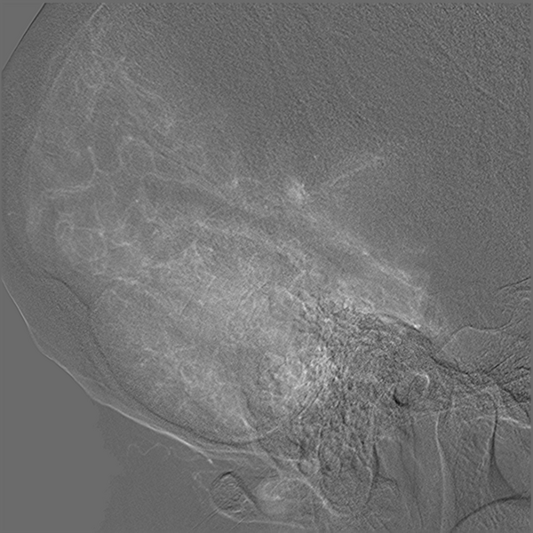 File:Normal cerebral angiogram (four vessel DSA) (Radiopaedia 41708-44649 R 15).png