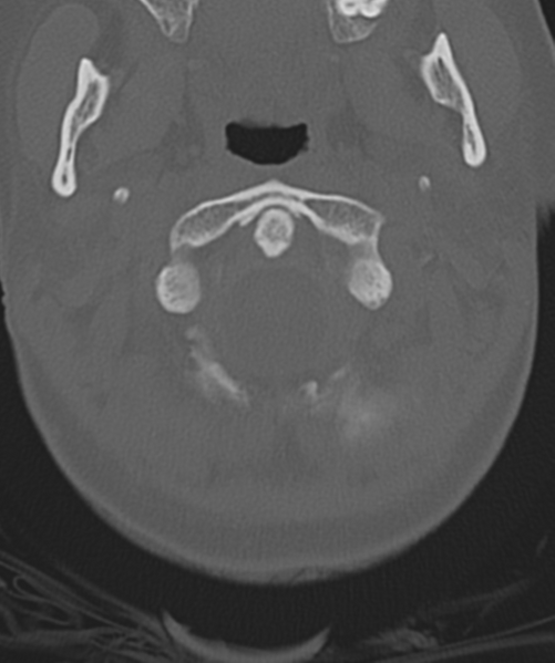 File:Normal cervical spine MRI (including Dixon) (Radiopaedia 42762-45926 Axial bone window 10).png