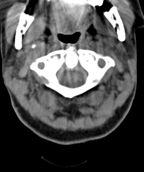 File:Normal cervical spine MRI (including Dixon) (Radiopaedia 42762-45926 Axial non-contrast 12).png